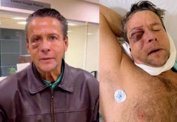 Alfredo Adame se opera tras golpiza y casi perder la vista en asalto