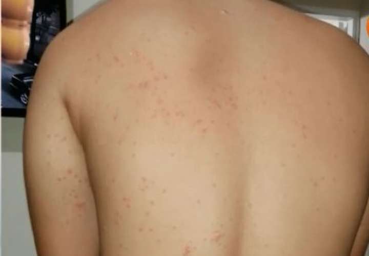 Brote alérgico mantiene preocupados a residentes de Praderas del Norte