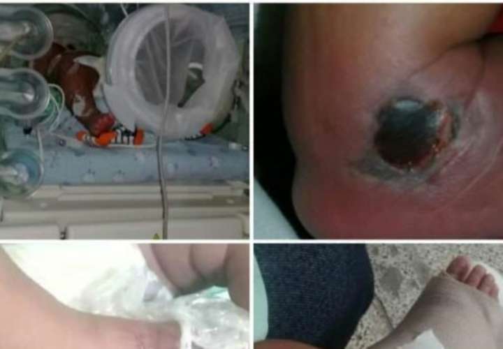Menor sufrió quemadas químicas en hospital