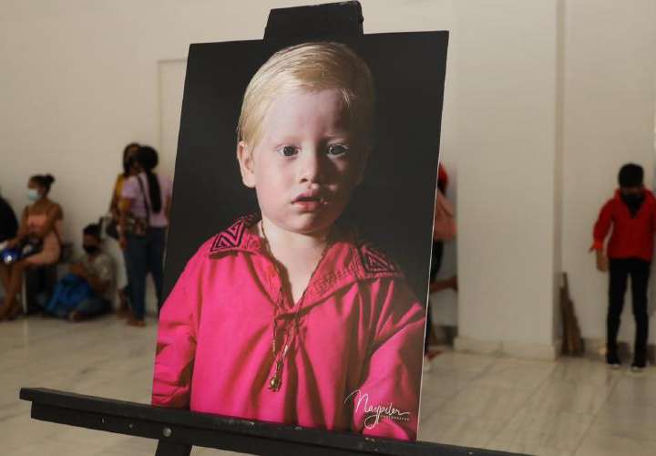 Exposición para crear conciencia sobre el albinismo