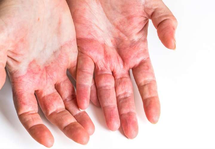 Dermatitis atópica: Una condición común y poco comprendida