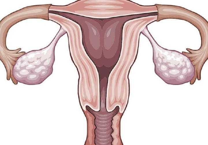 Cuidado con el cáncer de ovario