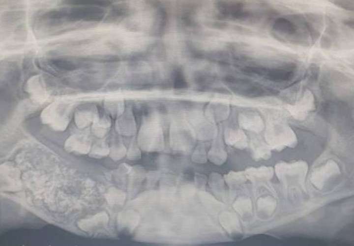 Niño de 7 años cogió en el dolor con sus 526 dientes 