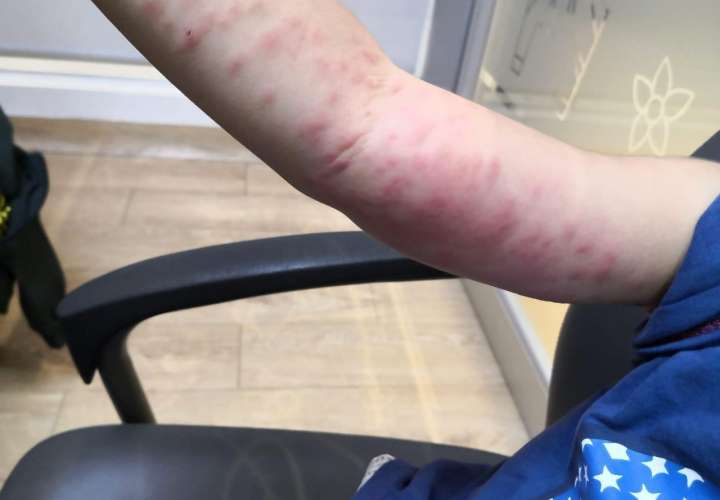Minsa: Aumentan casos de alergia causada por pelusa de la polilla 'Hylesia'