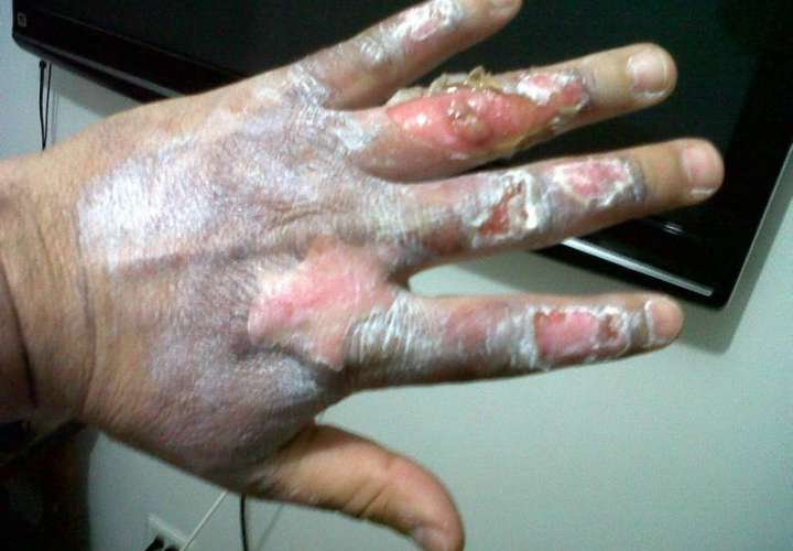 Hombre pierde tres dedos de sus manos al explotar bombitas