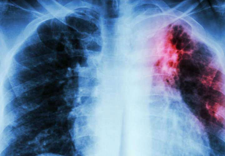 Médicos contagiados por tuberculosis