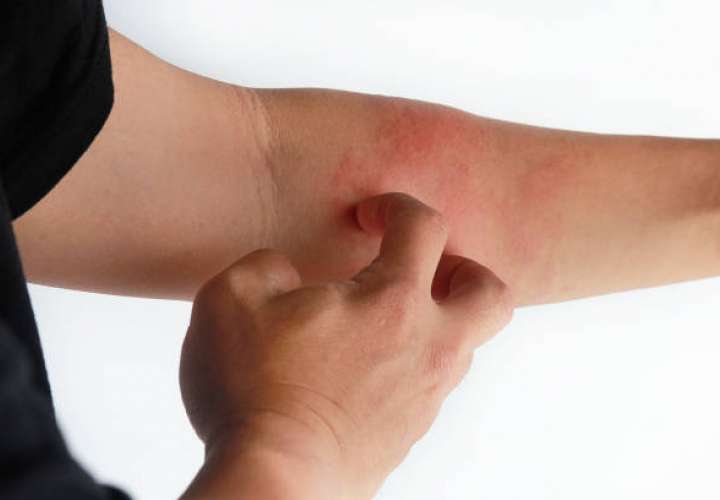 Catalogada como una enfermedad inflamatoria, afecta a la piel que cursa con prurito (picor) .