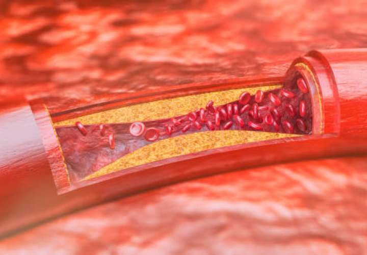 Vista de una arteria engrosada. Imagen ilustrativa