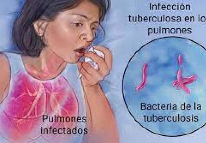 Más de 700 nuevos casos de tuberculosis en el país