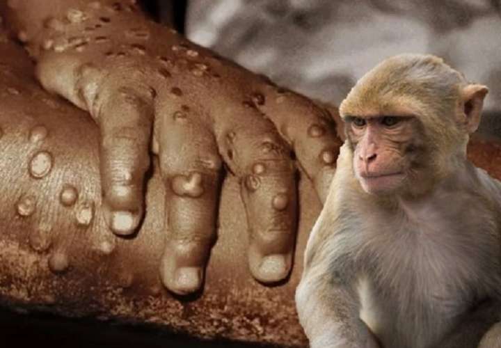 Italiano se infecta con covid, VIH y viruela de mono al mismo tiempo