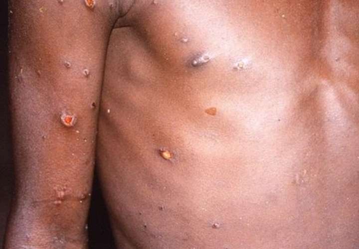 Aumentan a 16 los casos de viruela símica en el país