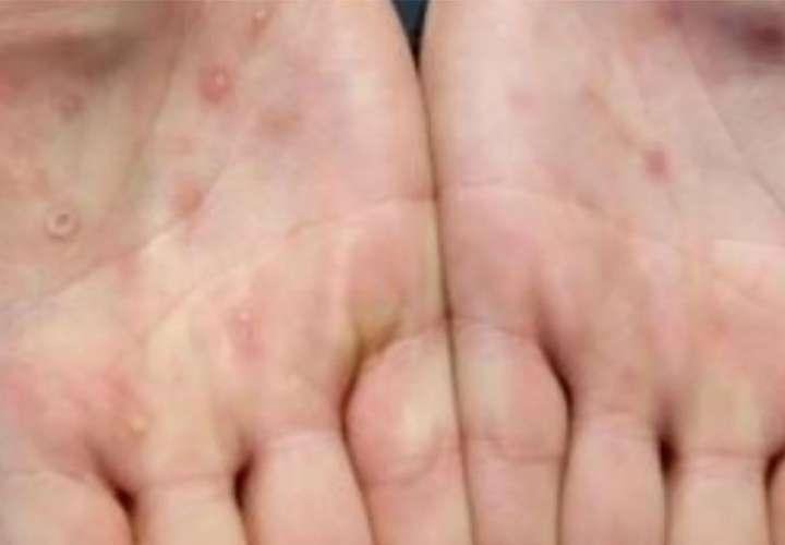 Las lesiones de la viruela del mono suelen aparecer en las palmas de las manos. Foto: OMS / CDC