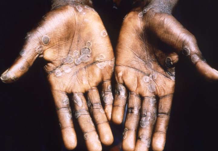 Imagen de las lesiones en la piel provocadas por la viruela del mono, durante un estudio llevado a cabo en la República Democrática del Congo entre los años 1996 y 1997. EFE