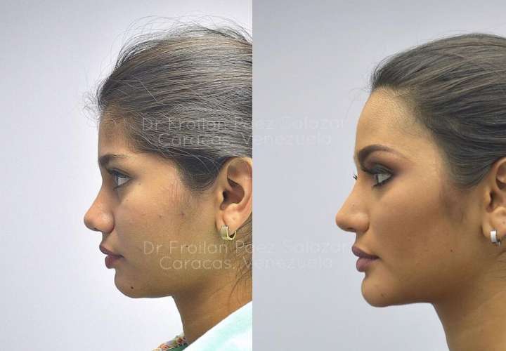 Difunden fotos de la Miss Venezuela antes de someterse a varias cirugías