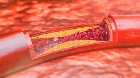 Vista de una arteria engrosada. Imagen ilustrativa