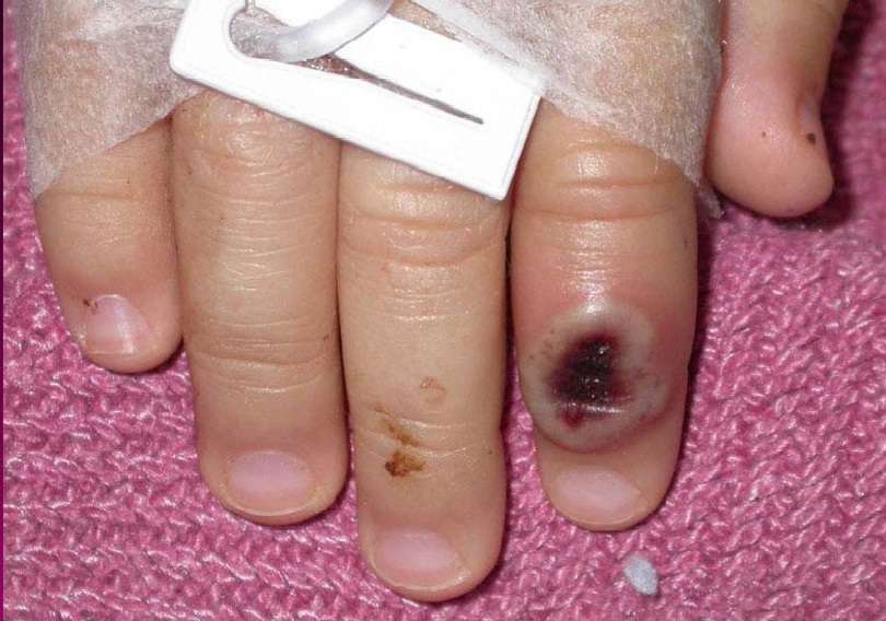 Fotografía de archivo del Centro Estadounidense de Control de las Enfermedades (CDC) en la que se aprecia el dedo de un niño infectado por la llamada &quot;&quot;viruela de mono&quot;&quot; (monkeypox). EFE