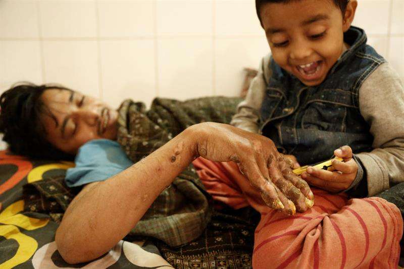 El prolongado tratamiento y la decisión de los doctores de mantener a Bajandar internado también está pasando factura a su familia. /  Foto: EFE