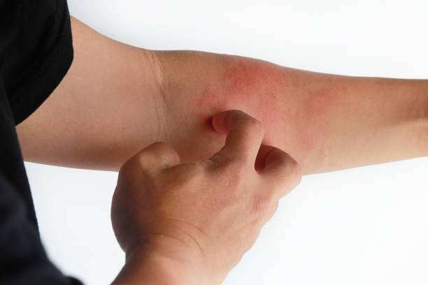 Catalogada como una enfermedad inflamatoria, afecta a la piel que cursa con prurito (picor) .