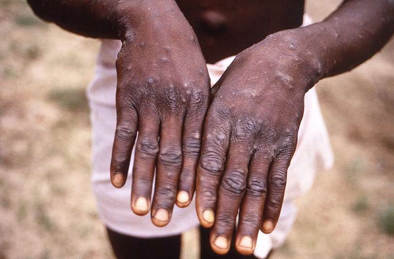 Un joven muestra sus manos durante un brote de viruela del mono en la República Democrática del Congo. Foto: Naciones Unidad - Archivo 