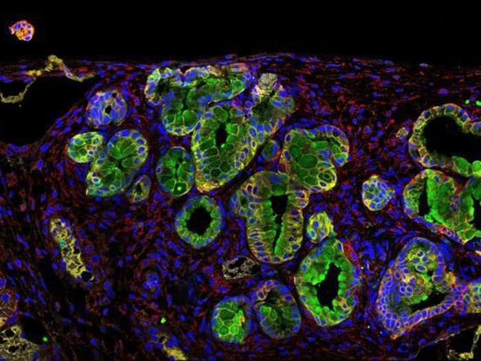 En la imagen, inmunofluorescencia de un tumor de páncreas, con esa proteína en verde. Imagen Bruno Sainz / EFE