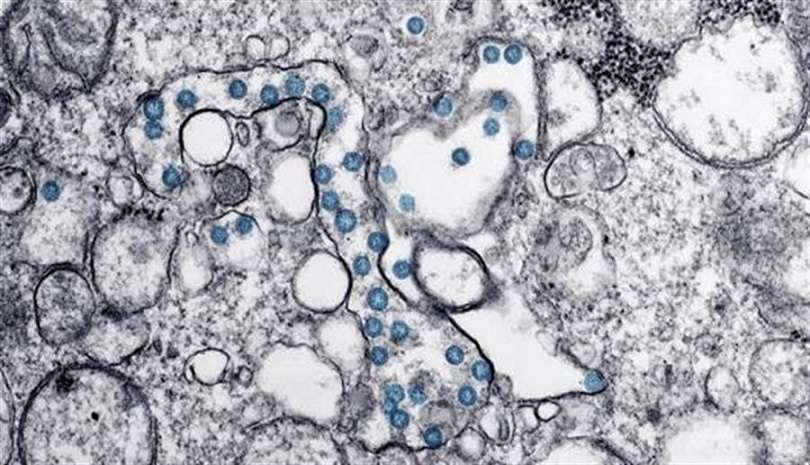 Partículas del virus SARS-CoV-2, coloreadas en azul, en una imagen de microscopio de electrones. EFE